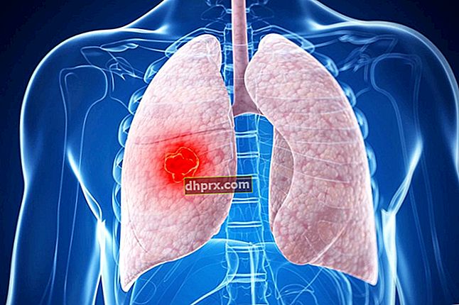 Causa di polmonite influenzale non trattata correttamente