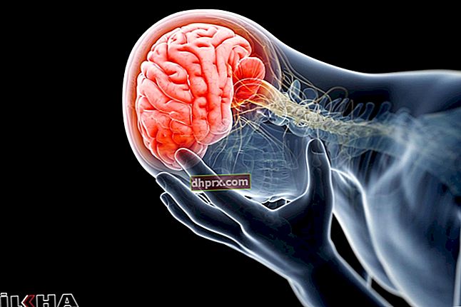 Attenzione ai 16 sintomi dell'emorragia cerebrale!