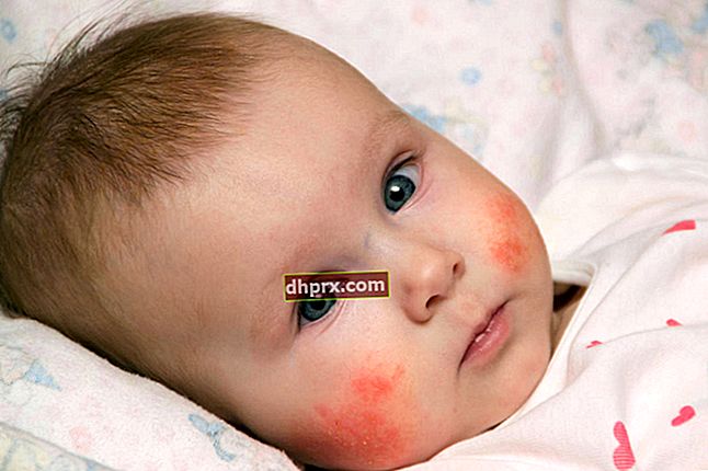 Attenzione all'allergia al latte nei neonati!